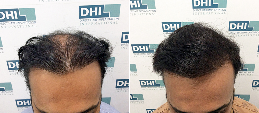 DHI before & after hair transplant results